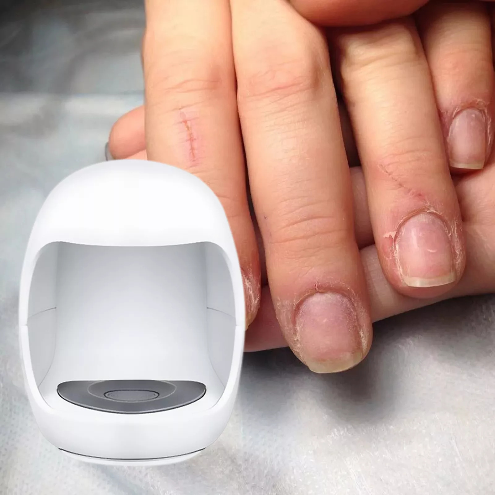 toenail-fungus-treatment-device-41190531_5.jpg